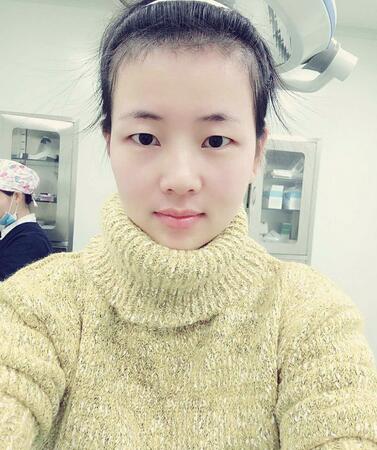 楊勇山雙眼皮案例展示