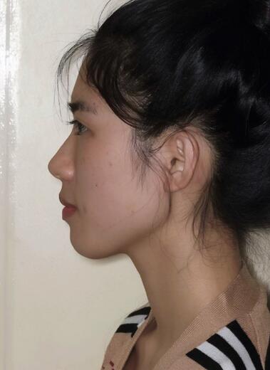 術(shù)前側(cè)面：