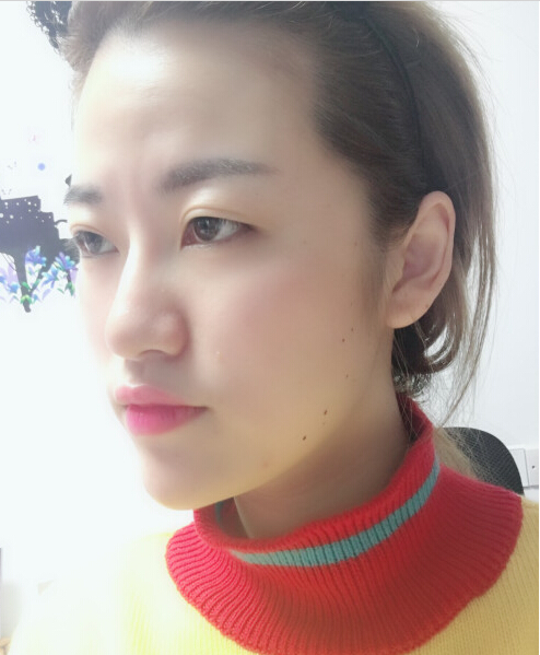 成都藝星陳遠(yuǎn)琨醫(yī)生注射肉毒素瘦臉效果案例對(duì)比圖