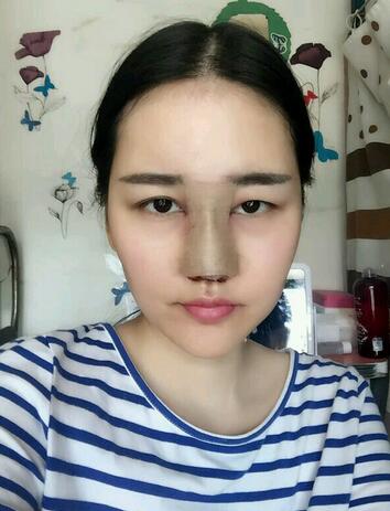 漢中韓美整形醫(yī)生常雙模假體隆鼻+耳軟骨墊鼻尖真實案例效果圖 漢中韓美整形醫(yī)生常雙模假體隆鼻+耳軟骨墊鼻尖真實案例效果圖