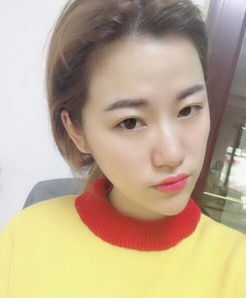 成都藝星陳遠(yuǎn)琨醫(yī)生注射肉毒素瘦臉效果案例對(duì)比圖