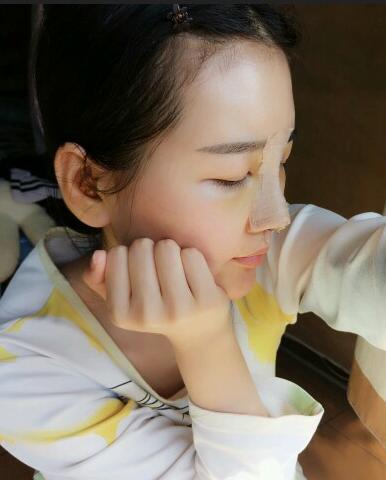 漢中韓美整形醫(yī)生常雙模假體隆鼻+耳軟骨墊鼻尖真實案例效果圖 漢中韓美整形醫(yī)生常雙模假體隆鼻+耳軟骨墊鼻尖真實案例效果圖