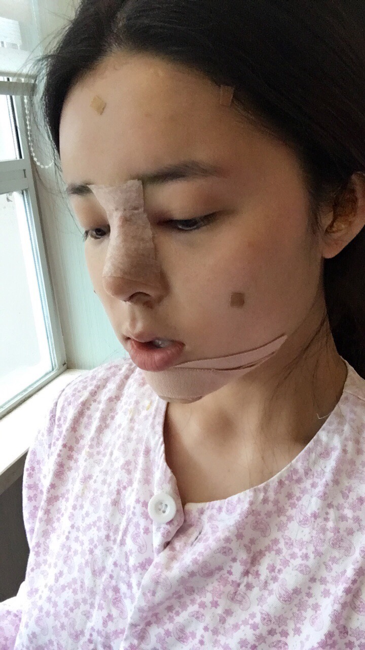 北京世濟周志強醫(yī)生鼻綜合案例 北京世濟周志強醫(yī)生鼻綜合案例