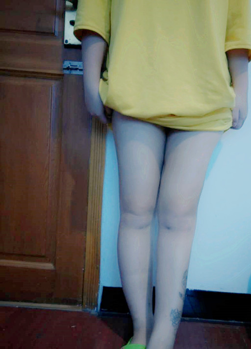 廣州軍頤醫(yī)院整形美容中心石建薇醫(yī)生腰腹吸脂真實(shí)案例對(duì)比圖 廣州軍頤醫(yī)院整形美容中心石建薇醫(yī)生腰腹吸脂真實(shí)案例對(duì)比圖