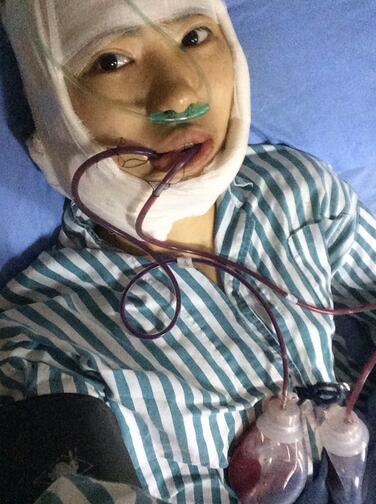 下頜角手術(shù)當(dāng)天