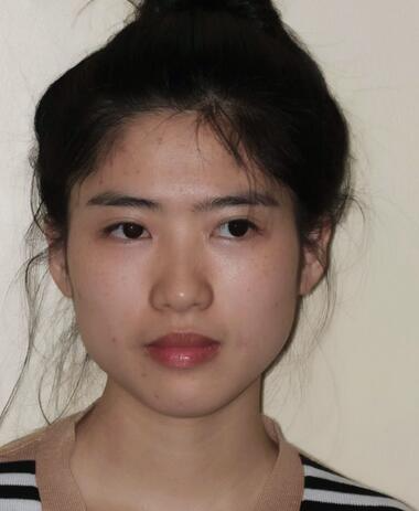 北京彤美整形醫(yī)院趙彤醫(yī)生做下頜角整形怎么樣？下頜角整形案例展示