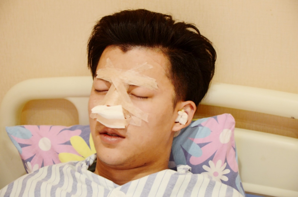 濟寧名美醫(yī)療整形醫(yī)生李唯少假體隆鼻+耳軟骨墊鼻尖真實案例效果對比圖 濟寧名美醫(yī)療整形醫(yī)生李唯少假體隆鼻+耳軟骨墊鼻尖真實案例效果對比圖