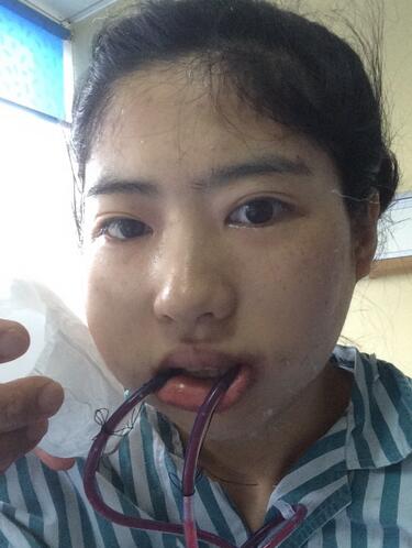 下頜角手術(shù)第二天