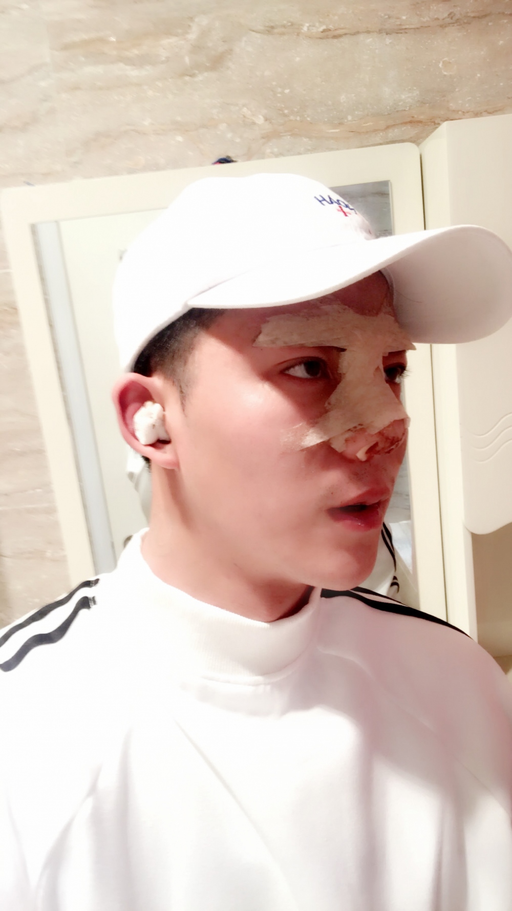 濟寧名美醫(yī)療整形醫(yī)生李唯少假體隆鼻+耳軟骨墊鼻尖真實案例效果對比圖 濟寧名美醫(yī)療整形醫(yī)生李唯少假體隆鼻+耳軟骨墊鼻尖真實案例效果對比圖