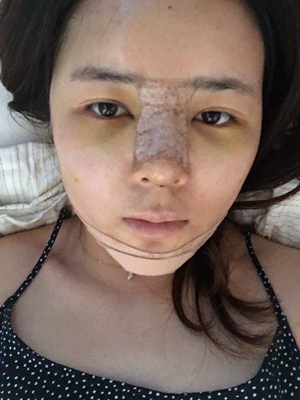 北京世濟周志強醫(yī)生鼻綜合案例 北京世濟周志強醫(yī)生鼻綜合案例