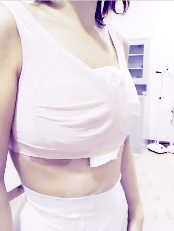 馬戰(zhàn)勝自體脂肪隆胸案例效果對比圖