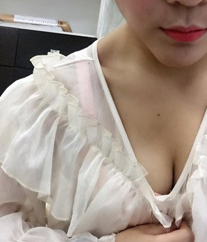 深圳南西子黃藝做自體脂肪隆胸案例效果對(duì)比圖