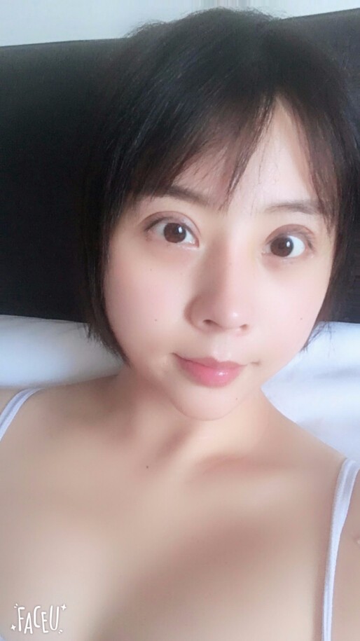 成都晶都醫(yī)療美容醫(yī)院王教授做自體脂肪填充+大腿吸脂+假體隆胸案例分享