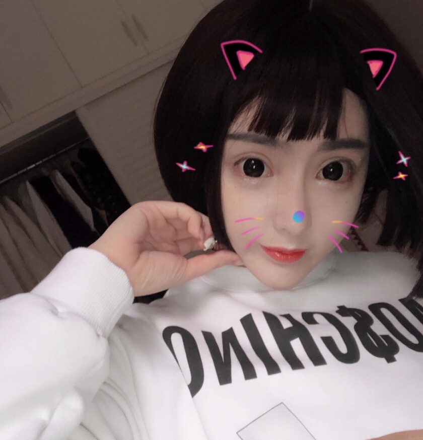 重慶柏漫醫(yī)療美容診所高紅艷醫(yī)生做面部吸脂怎么樣？面部吸脂案例分享