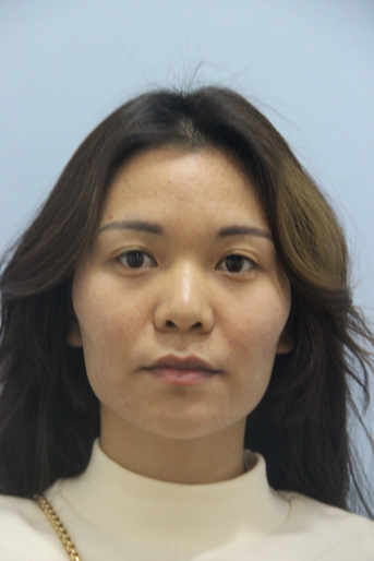 長(zhǎng)沙星雅醫(yī)療美容醫(yī)院做埋線提升去法令紋效果怎么樣？附金振玉醫(yī)生案例