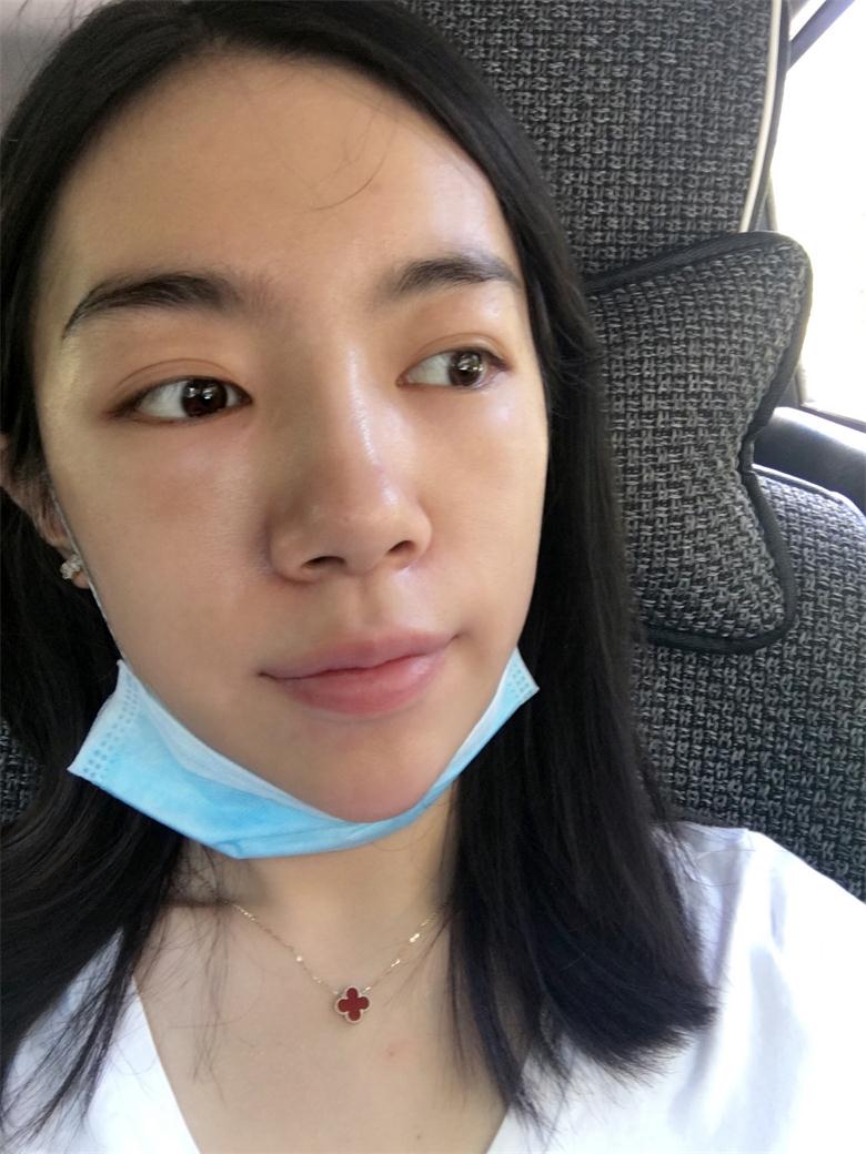 合肥壹加壹整形美容醫(yī)院做祛眼袋效果怎么樣？金大生祛眼袋案例分享