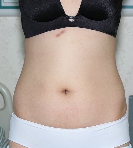 深圳晨曦整形醫(yī)院吉米斯做腰腹吸脂怎么樣？附吉米斯醫(yī)生腰腹吸脂案例