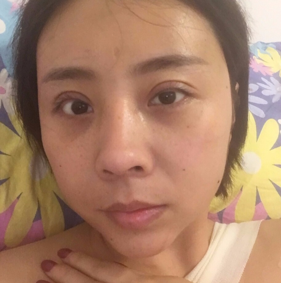 成都晶都醫(yī)療美容醫(yī)院王教授做自體脂肪填充+大腿吸脂+假體隆胸案例分享