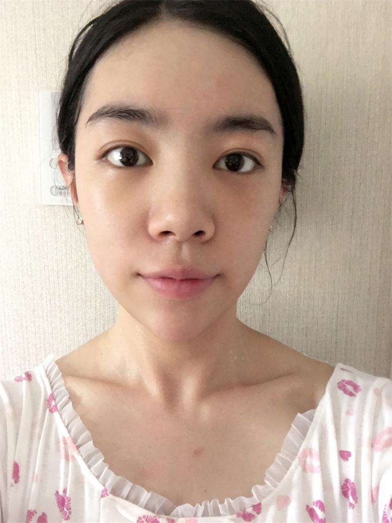 合肥壹加壹整形美容醫(yī)院做祛眼袋效果怎么樣？金大生祛眼袋案例分享