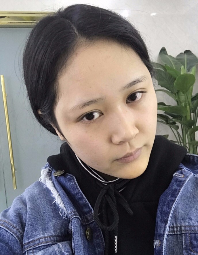 趙煜楠醫(yī)生硅膠墊下巴真人案例