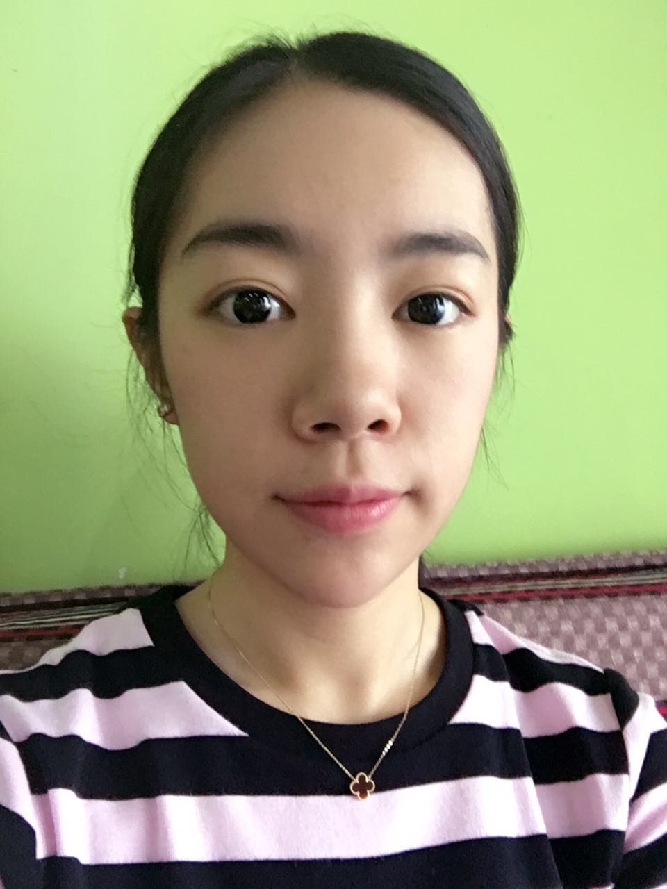 做完祛眼袋手術(shù)4天