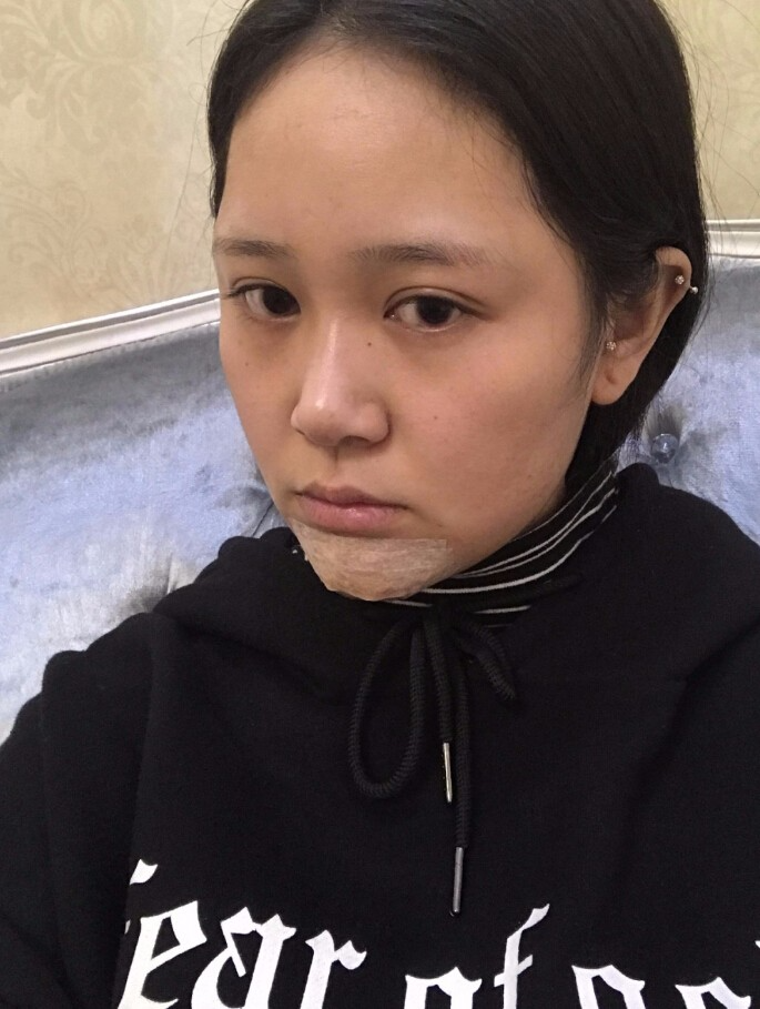 青島集美整形醫(yī)院做硅膠墊下巴怎么樣？趙煜楠醫(yī)生硅膠墊下巴真人案例