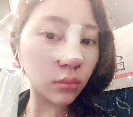 蘇州明基醫(yī)院醫(yī)療美容科做鼻綜合整形怎么樣？蘇州明基鼻綜合整形案例