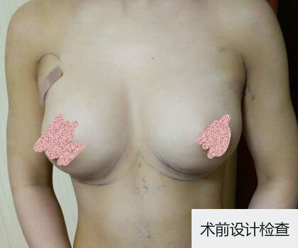 深圳博美整形醫(yī)生劉超做自體脂肪隆胸怎么樣？自體脂肪隆胸案例