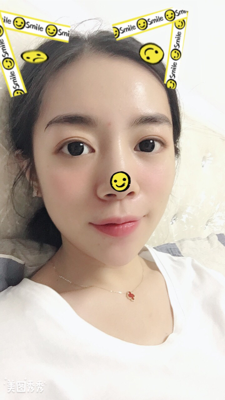 做完祛眼袋手術(shù)22天