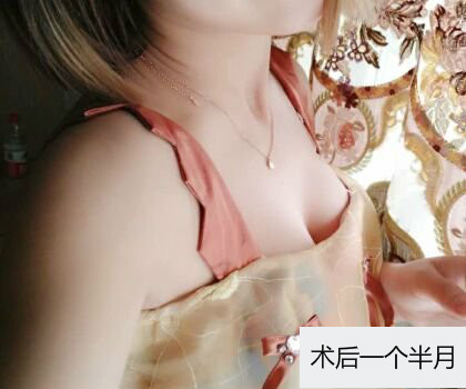 深圳博美整形醫(yī)生劉超做自體脂肪隆胸怎么樣？自體脂肪隆胸案例