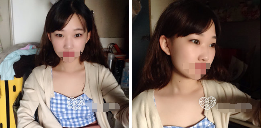 珠海艾瑞醫(yī)療美容醫(yī)院余昌盛醫(yī)生做耳軟骨隆鼻真實(shí)案例分享 珠海艾瑞醫(yī)療美容醫(yī)院余昌盛醫(yī)生做耳軟骨隆鼻真實(shí)案例分享