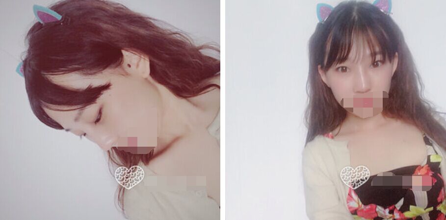 珠海艾瑞醫(yī)療美容醫(yī)院余昌盛醫(yī)生做耳軟骨隆鼻真實(shí)案例分享 珠海艾瑞醫(yī)療美容醫(yī)院余昌盛醫(yī)生做耳軟骨隆鼻真實(shí)案例分享