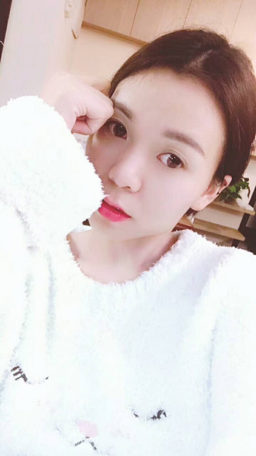 長(zhǎng)沙星雅醫(yī)療美容醫(yī)院做埋線提升去法令紋效果怎么樣？附金振玉醫(yī)生案例