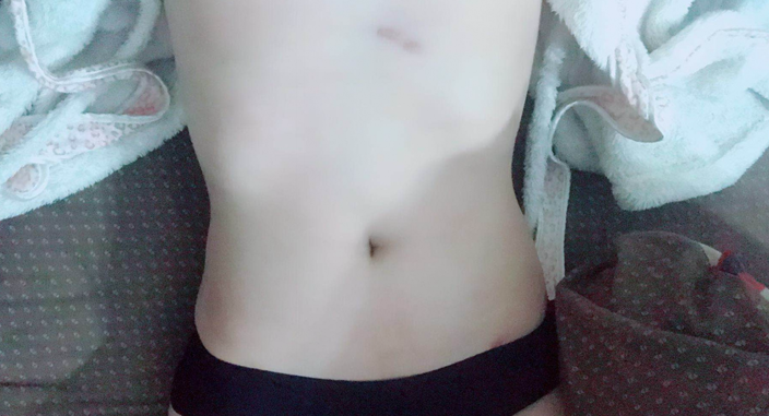 深圳晨曦整形醫(yī)院吉米斯做腰腹吸脂怎么樣？附吉米斯醫(yī)生腰腹吸脂案例