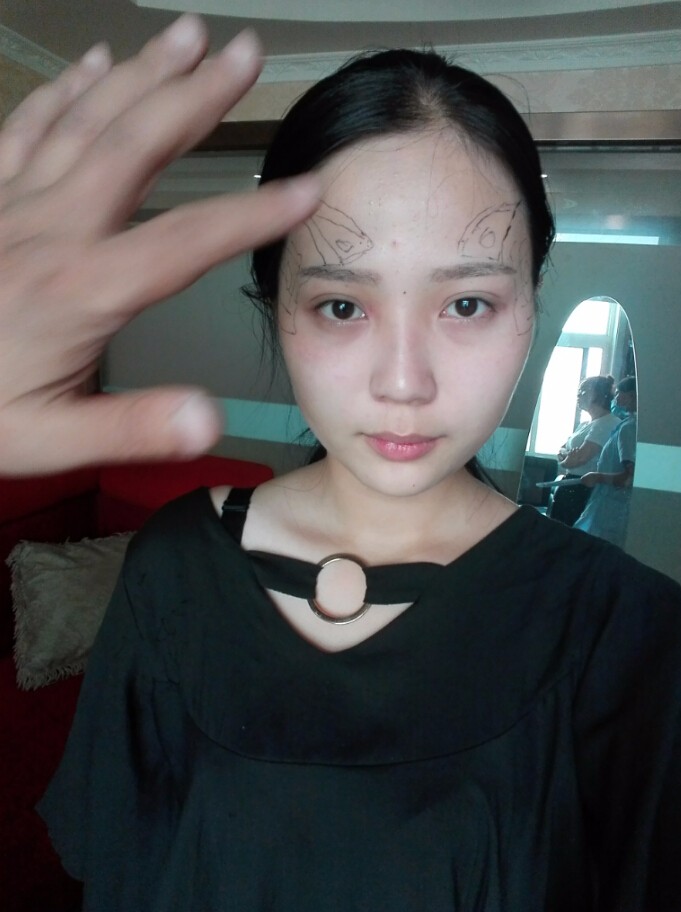 西安華仁醫(yī)院整形美容中心做自體脂肪填充效果怎么樣？附耿延鵬整形案例