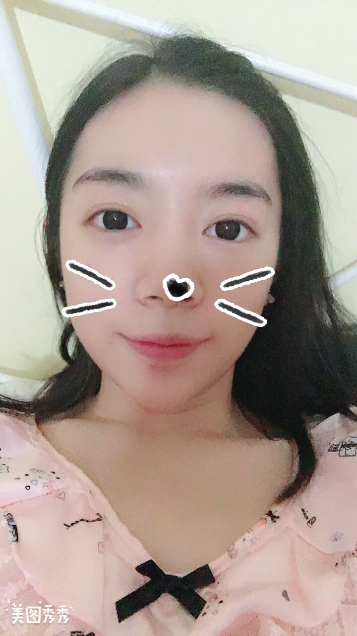 做完祛眼袋手術(shù)41天