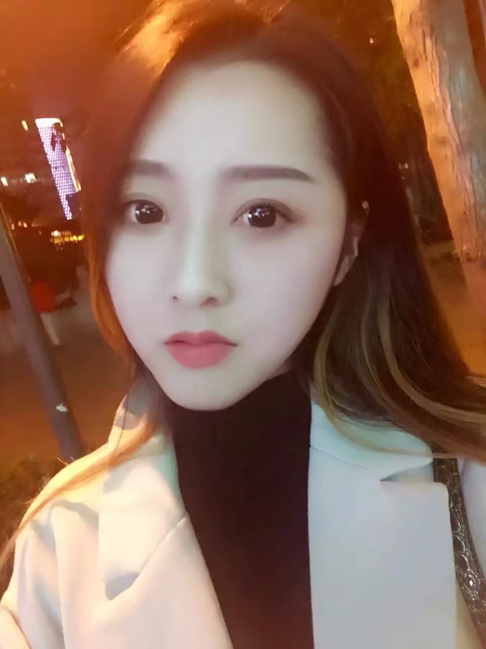 西安米蘭柏羽整形醫(yī)院李旭平做切開雙眼皮效果怎么樣？附案例