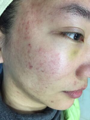 重慶柏漫醫(yī)療美容診所做激光祛痘效果怎么樣？白亞亞激光祛痘案例