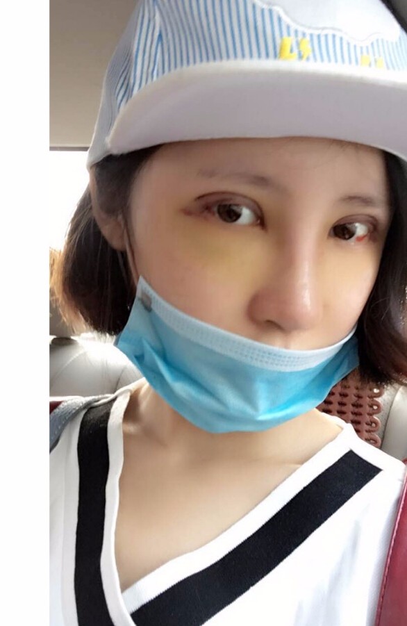 長沙愛思特整形醫(yī)院陳星光醫(yī)生做鼻部多項+自體脂肪隆鼻+切開雙眼皮+開外眼角案例