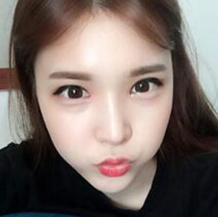 象山華美整形美容醫(yī)院趙誠厚醫(yī)生做切開雙眼皮+開內(nèi)眼角整形案例 象山華美整形美容醫(yī)院趙誠厚醫(yī)生做切開雙眼皮+開內(nèi)眼角整形案例