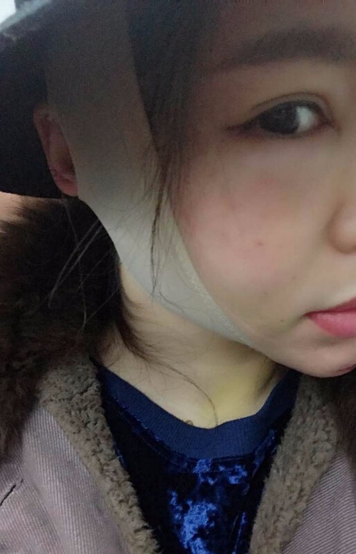 重慶聯(lián)合麗格美容醫(yī)院林麗蓉醫(yī)生做自體脂肪豐蘋果肌怎么樣？附案例