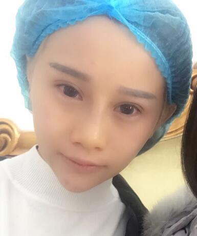 長春奧拉克美容醫(yī)院金相勛醫(yī)生做玻尿酸豐臥蠶怎么樣？附案例