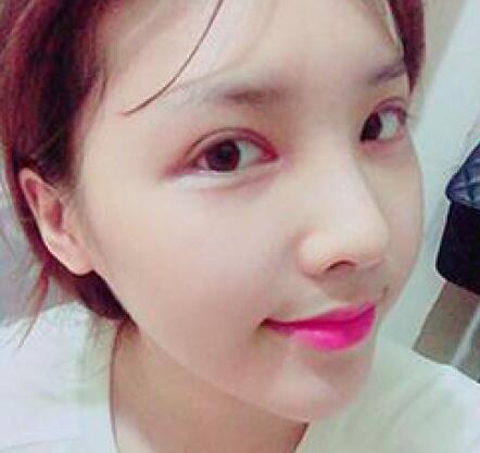 象山華美整形美容醫(yī)院趙誠厚醫(yī)生做切開雙眼皮+開內(nèi)眼角整形案例 象山華美整形美容醫(yī)院趙誠厚醫(yī)生做切開雙眼皮+開內(nèi)眼角整形案例