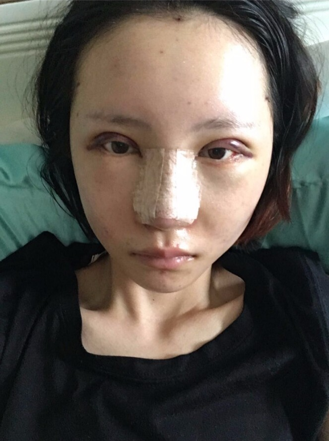 長(zhǎng)沙愛(ài)思特整形醫(yī)院陳星光醫(yī)生做鼻部多項(xiàng)+自體脂肪隆鼻+切開雙眼皮+開外眼角案例