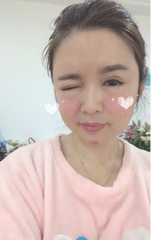 重慶聯(lián)合麗格美容醫(yī)院林麗蓉醫(yī)生做自體脂肪豐蘋果肌怎么樣？附案例