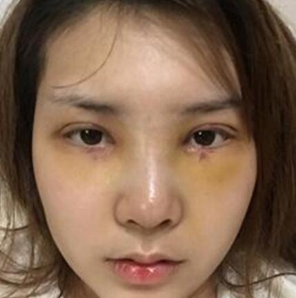 象山華美整形美容醫(yī)院趙誠厚醫(yī)生做切開雙眼皮+開內(nèi)眼角整形案例 象山華美整形美容醫(yī)院趙誠厚醫(yī)生做切開雙眼皮+開內(nèi)眼角整形案例