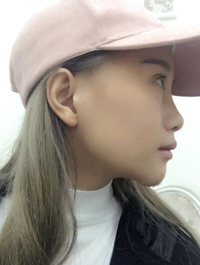 長春奧拉克美容醫(yī)院金相勛醫(yī)生做玻尿酸豐臥蠶怎么樣？附案例