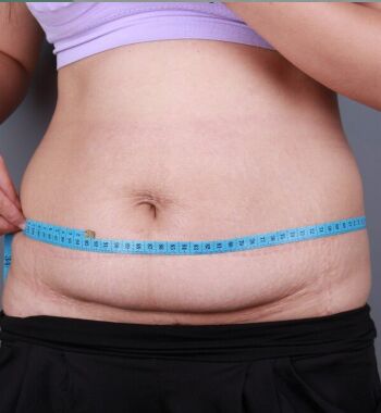 武漢東方麗人醫(yī)院整形美容科胡江偉醫(yī)生做腰腹吸脂案例效果對比圖