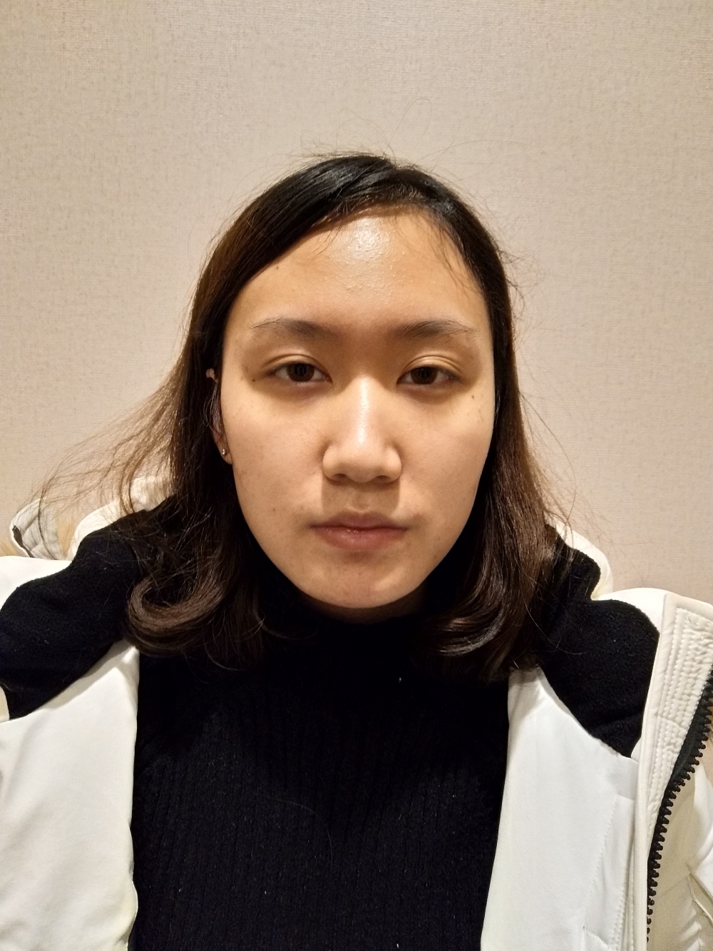 煙臺(tái)洛神醫(yī)學(xué)美容醫(yī)院張瑞允醫(yī)生做硅膠隆鼻怎么樣？附硅膠隆鼻案例