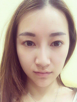 重慶五洲女子醫(yī)院整形美容中心做光子嫩膚怎么樣？淡明斌醫(yī)生光子嫩膚案例